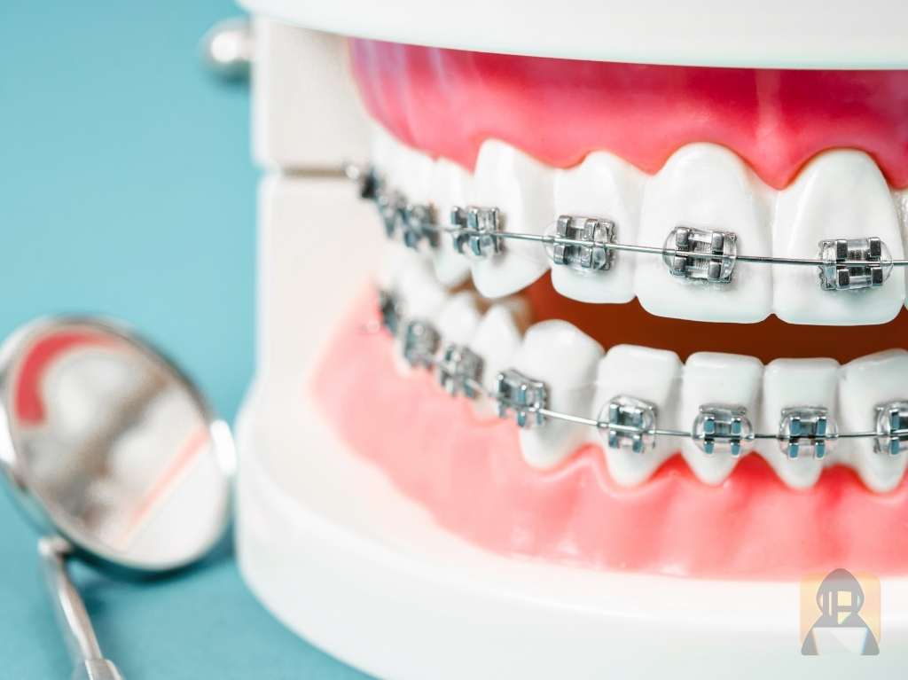 Braces May Change The Pronunciation Of Your Words